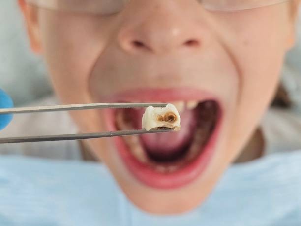 Best Emergency Dentist for Lost Fillings or Crowns in Collinsburg, PA